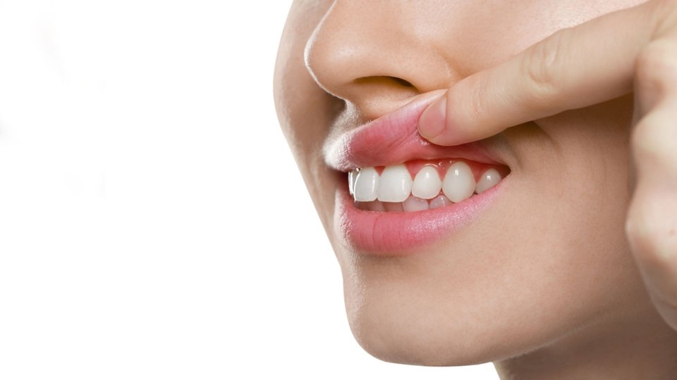 Diş eti çekilmesi, dişleri çevreleyen diş etinin aşınarak diş kökü üzerinden geri çekilmesi ve kök yüzeyinin açığa çıkmasıdır. 