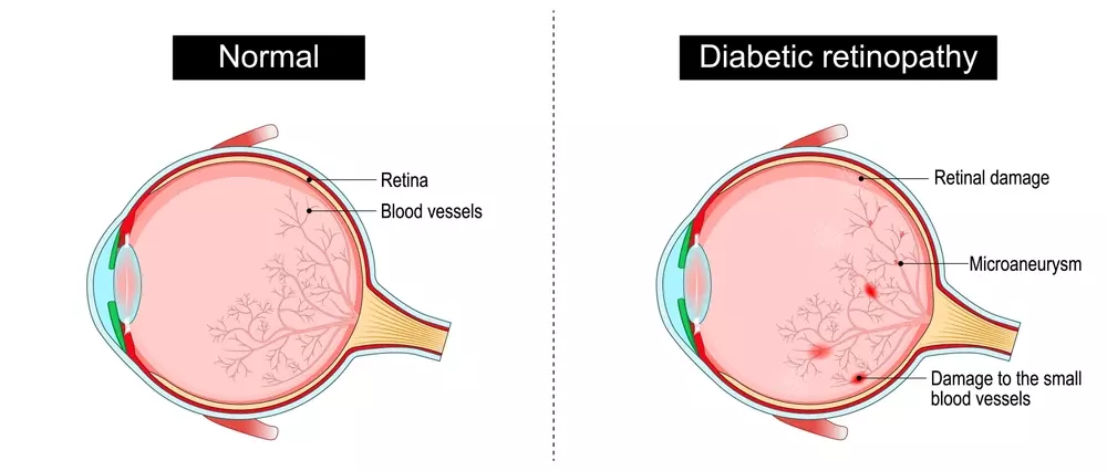 Diyabetik retinopati. Retina hasarı. İnsan gözünün enine kesiti. Diyabet. Makula, optik disk, koroid, retina, sklera ve foveanın yakın çekimi. Tıbbi durum. Mikroanevrizma