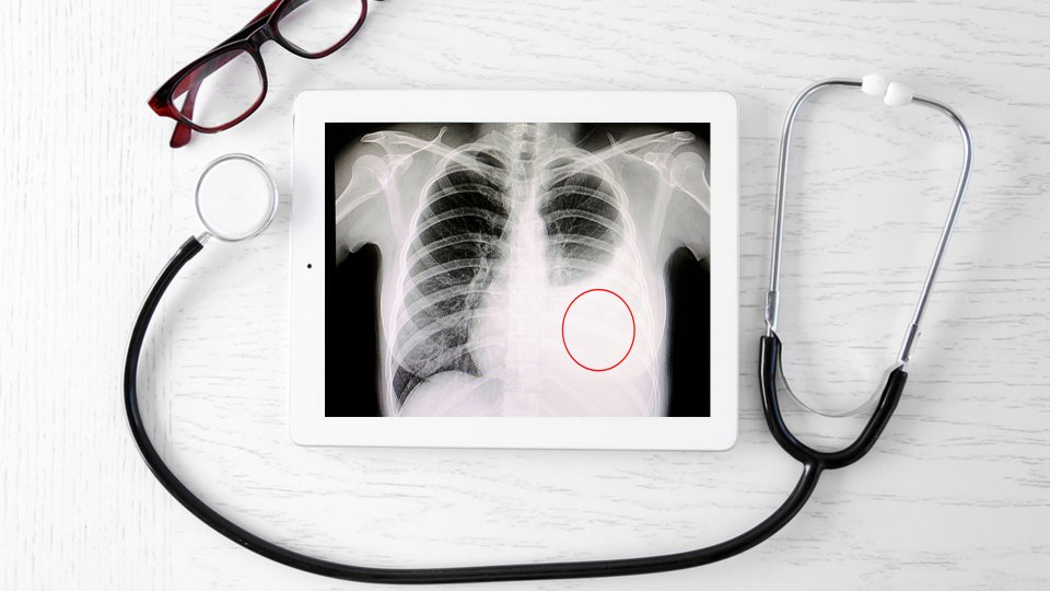 Akciğer Su Toplaması (Plevral Efüzyon) Belirtileri ve Tedavisi