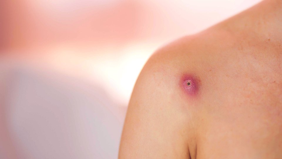 Apse Drenajı Nedir? Apse Drenajı Nasıl Uygulanır?