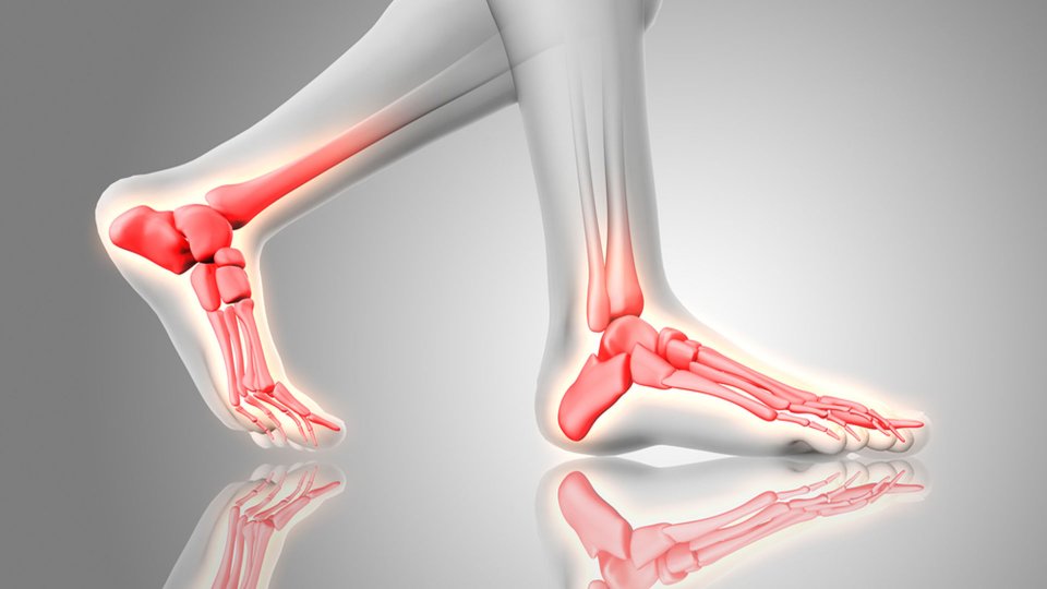 Artrodezi (Sabitleme) Ameliyatı Nedir? 