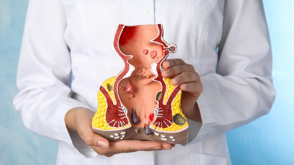 Hemoroid (Basur) Nedir? Belirtileri ve Tedavi Yöntemleri