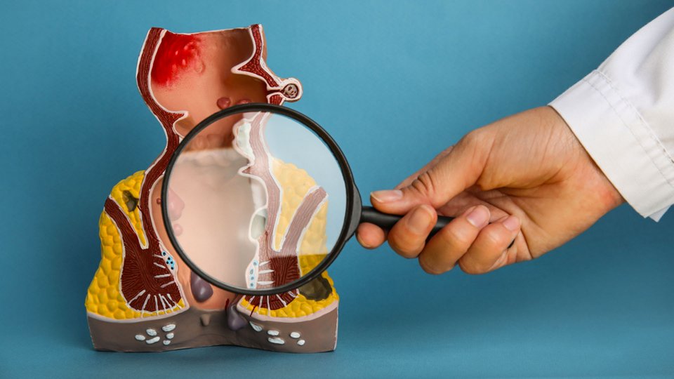 Basura Ne İyi Gelir? Hemoroide İyi Gelen 5 Etkili Öneri