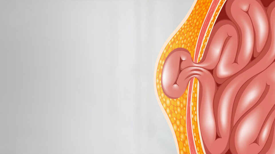 Bebek ve Çocuklarda Kasık Fıtığı