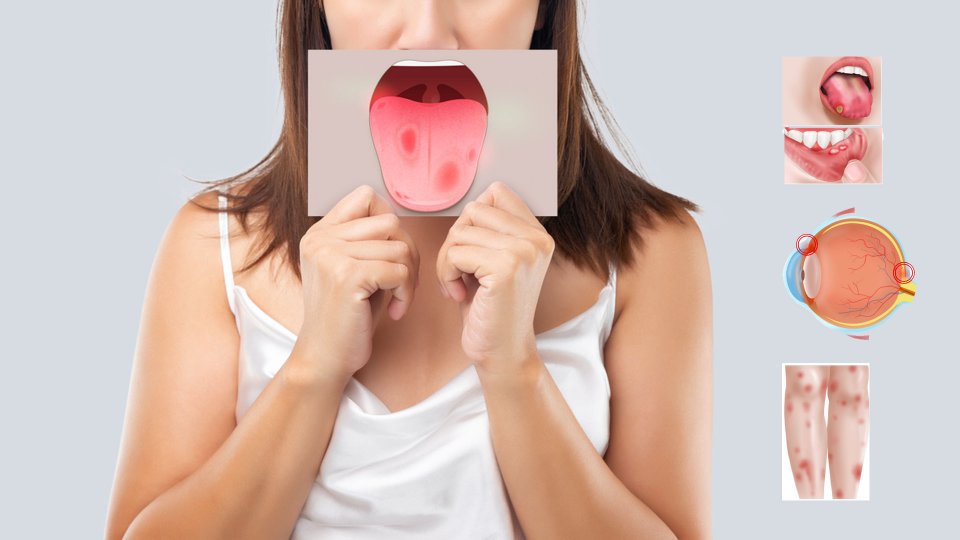 Behçet Hastalığı Nedir? Behçet Hastalığının Nedenleri Nelerdir?