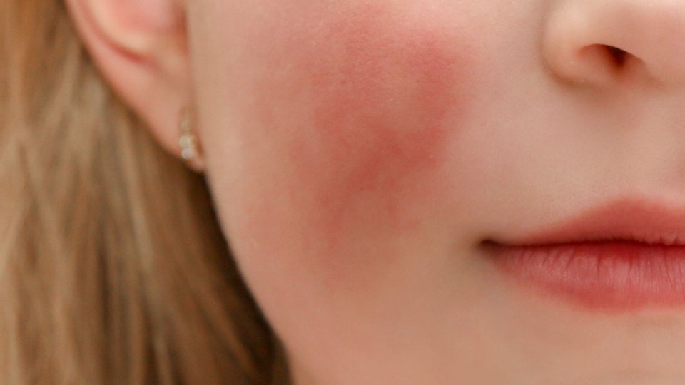 Parvovirüs (Beşinci Hastalık) Nedir? Parvovirüs Belirtileri Nelerdir?