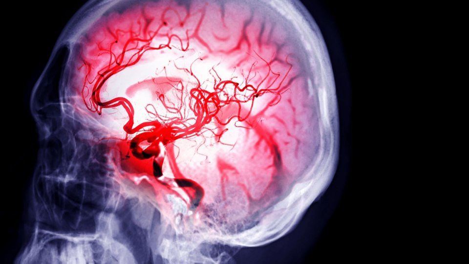 Beyin Damar Tıkanıklığı Belirtileri ve Tedavisi