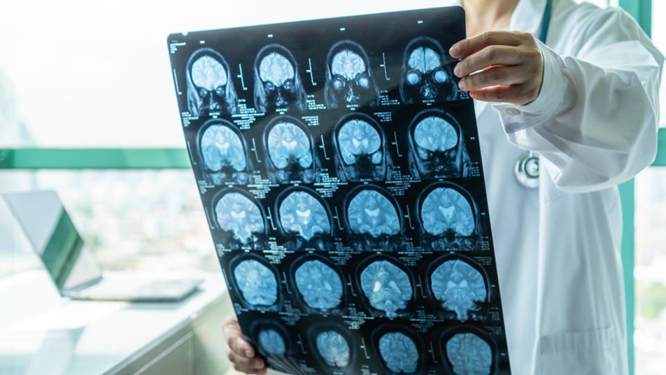 Beyin İltihabı (Ensefalit) Nedir?