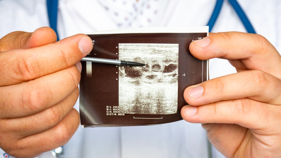 Böbrek Büyümesi (Hidronefroz) Nedir? Nasıl Tedavi Edilir?