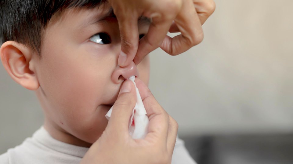 Çocuklarda Burun Kanaması (Epistaksis)