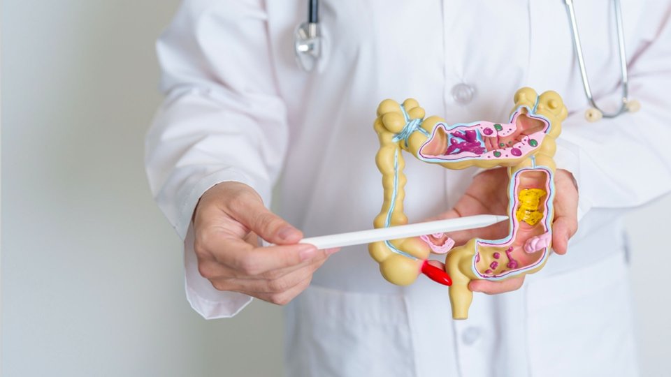 Divertikülit Nedir? Nasıl Tedavi Edilir?