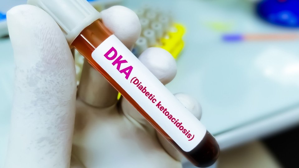 Diyabetik Ketoasidoz Nedir? Diyabetik Ketoasidoz Tedavisi Nasıldır?