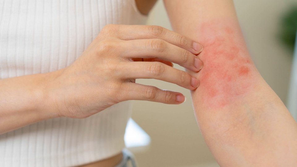 Diyabette Deri Hastalıkları ve Cilt Sorunları	