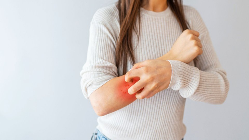 Egzama (Atopik Dermatit) Nedir ve Tedavi Yöntemleri Nelerdir?