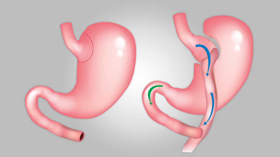 Gastrik By-Pass