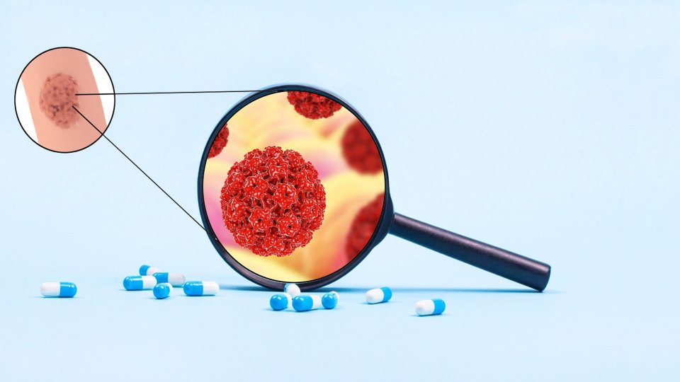 Genital Siğil Nedir? Genital Siğil Tedavisi Nasıldır?