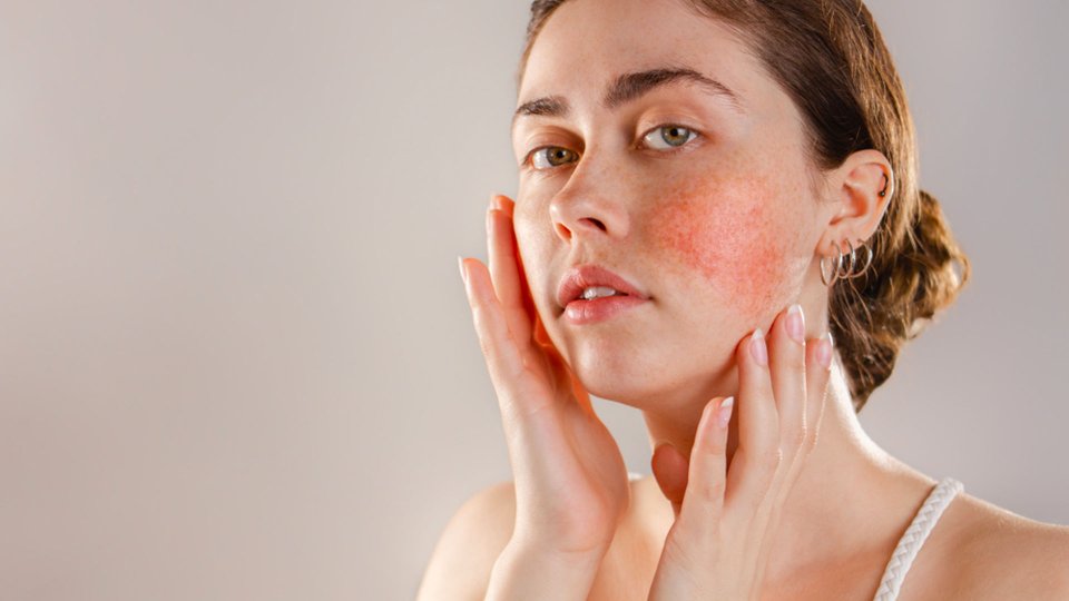 Gül Hastalığı (Rozasea) Nedir? Nedenleri, Belirtileri ve Tedavisi