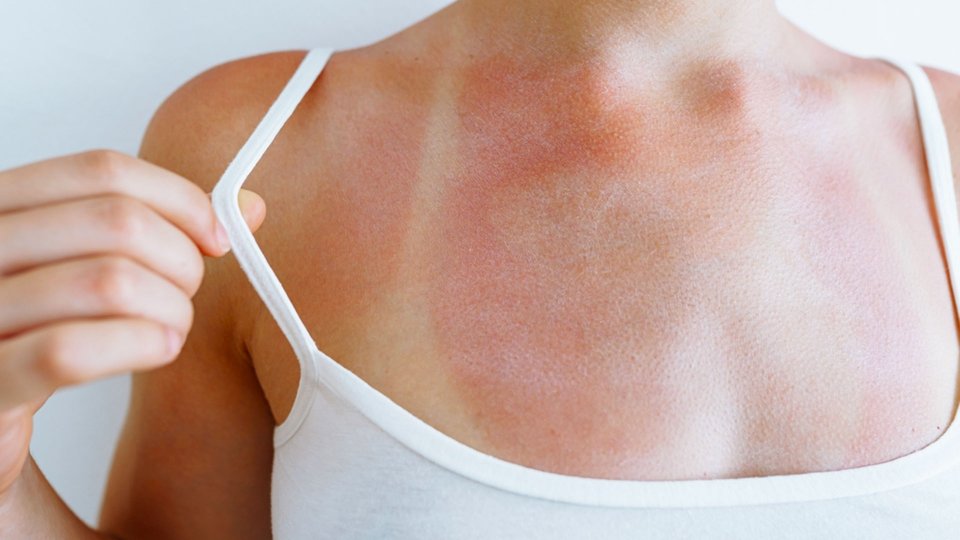 Güneş Alerjisi Nedir? Güneş Alerjisi Belirtileri Nelerdir?