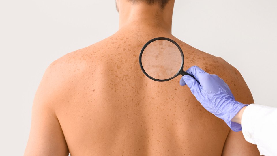 Güneş Lekeleri Nasıl Geçer?