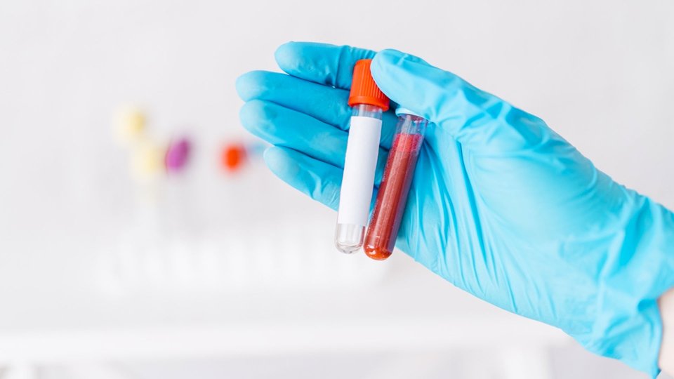 HCT Nedir? Kanda HTC Düşüklüğü Ne Anlama Gelir?