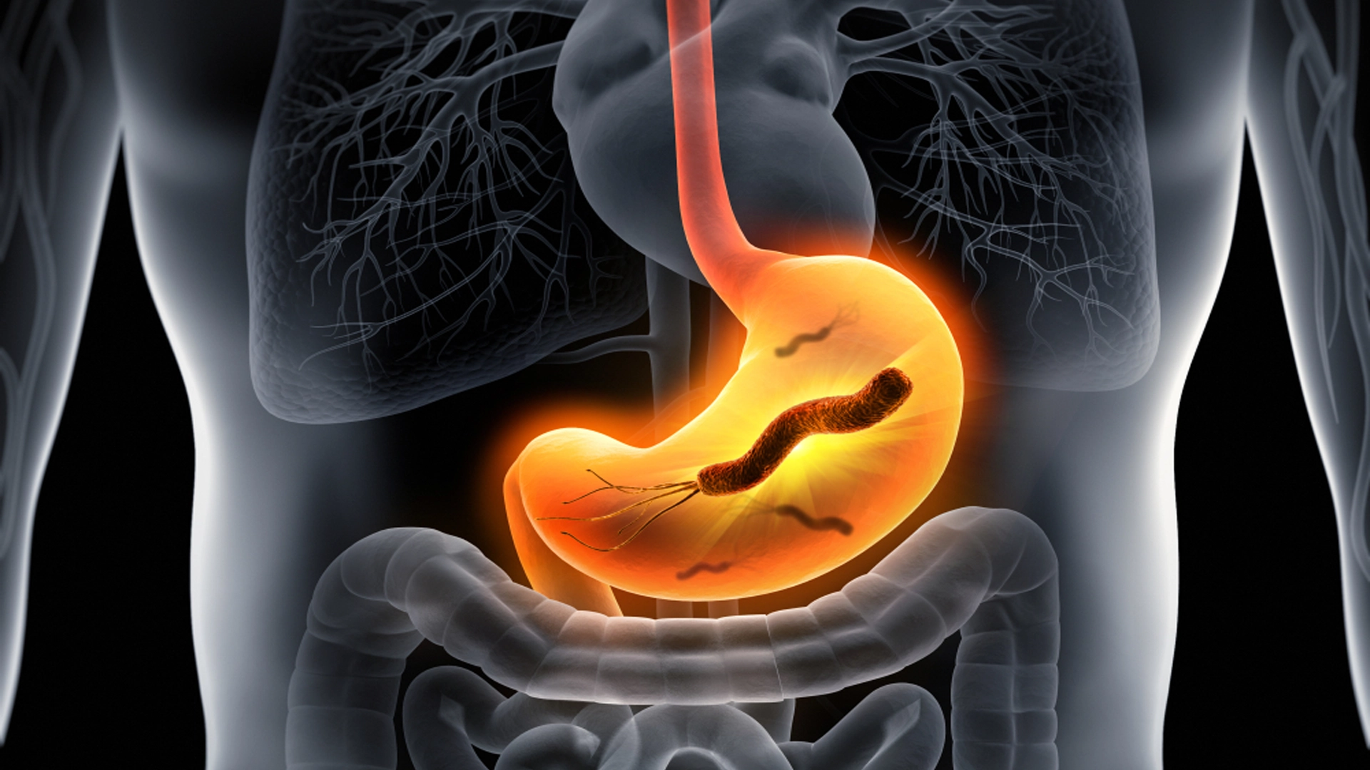 Helicobacter Pylori Mide Kanserine Neden Olabilir!