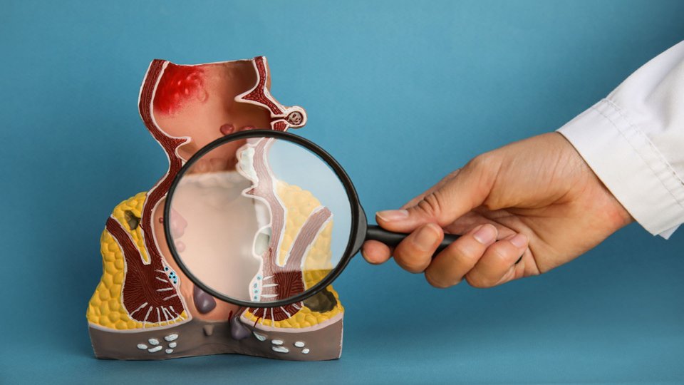 Hemoroid Ameliyatı Fiyatı Nedir? Nasıl Yapılır?