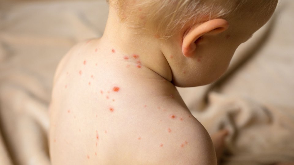 Henoch Scönlein Purpurası (HSP) Nedir?