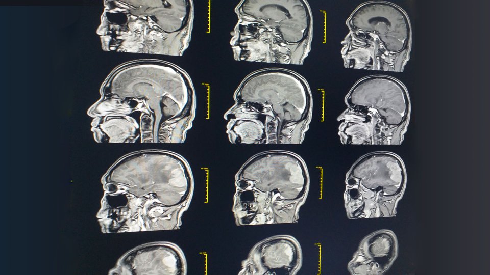 Kafa Kaidesi Tümörleri Mikrocerrahisi Nedir? Hangi Durumlarda Kullanılır?