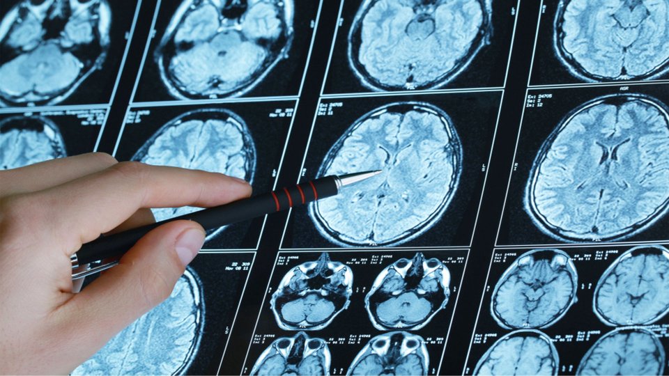 Kafa Tabanı Tümörü Nedir? Kafa Tabanı Tümörü Belirtileri Nelerdir?