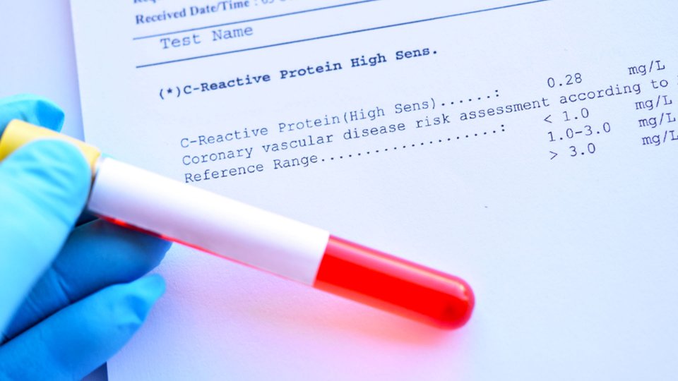 Kanser Hastalarında CRP Yüksekliği Kaç Olur?