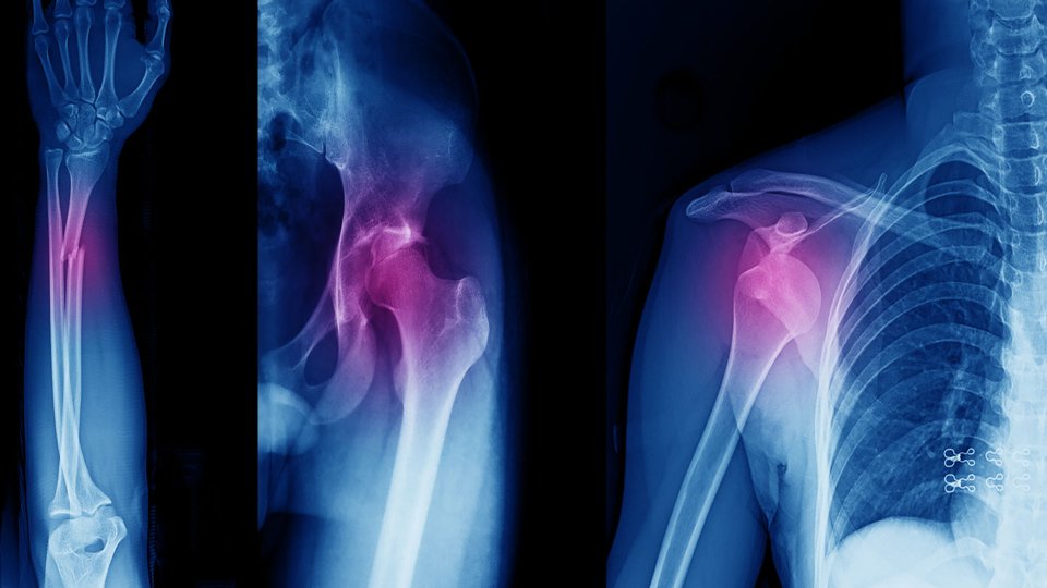 Kapalı Redüksiyon Nedir? Kapalı Redüksiyon Nasıl Yapılır?