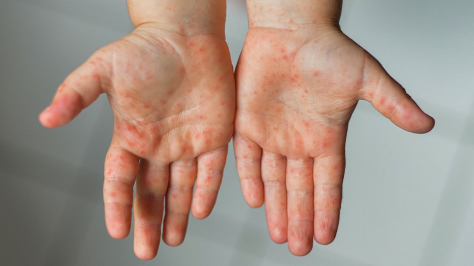 Kawasaki Hastalığı Nedir? Kawasaki Hastalığı Belirtileri Nelerdir?