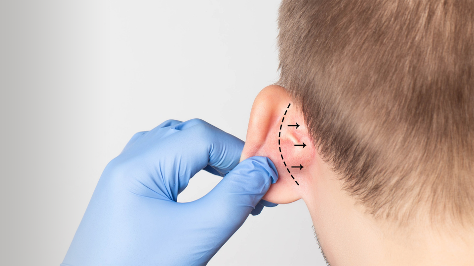 Kepçe Kulak Ameliyatı Fiyatı Nedir? Otoplasti Nasıl Uygulanır?