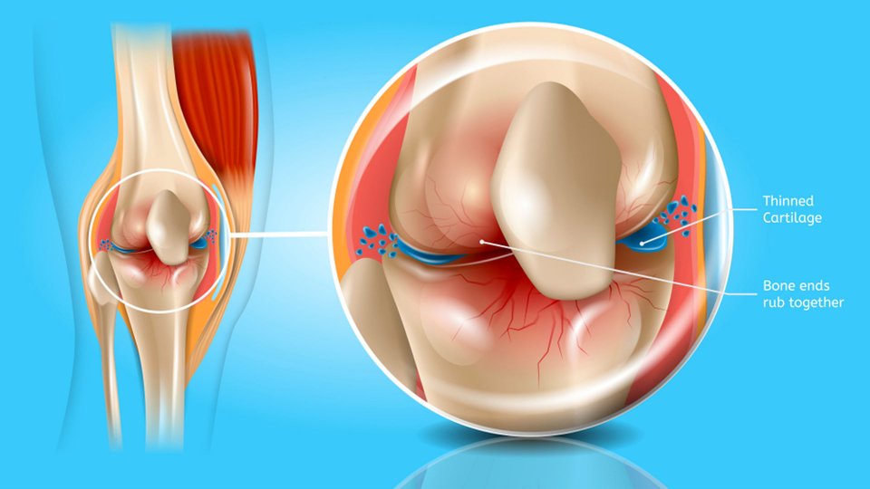 Osteoartrit (Kireçlenme) Nedir? Nasıl Tedavi Edilir?
