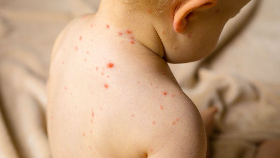 Kızamık (SSPE Hastalığı) Nedir? Belirtileri ve Tedavisi