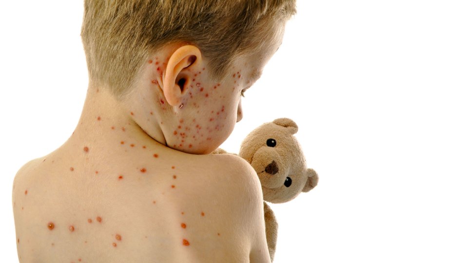 Kızamıkçık (Rubella) Nedir? Belirtileri ve Tedavi Yöntemleri