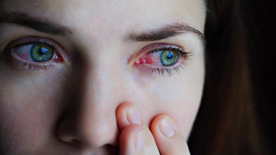 Konjonktivit (Kırmızı Göz Hastalığı) Nedir? Belirtileri Nelerdir?