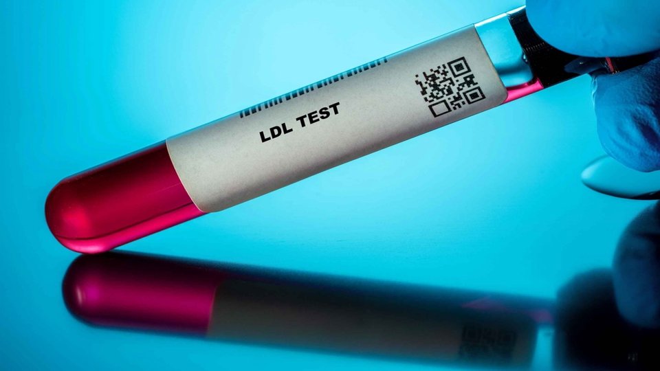 LDL Testi Nedir?