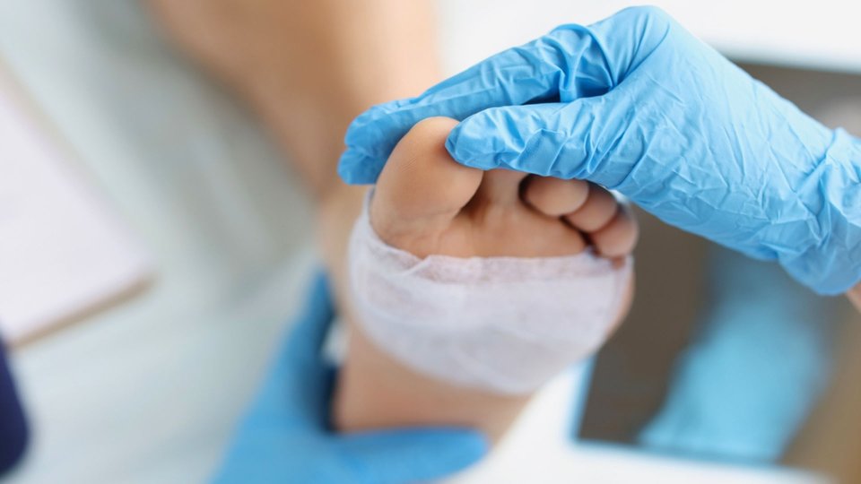 Larva ile Kronik Yara Tedavisi (Yarada Maggot Tedavisi / Kurtçuk Tedavisi)