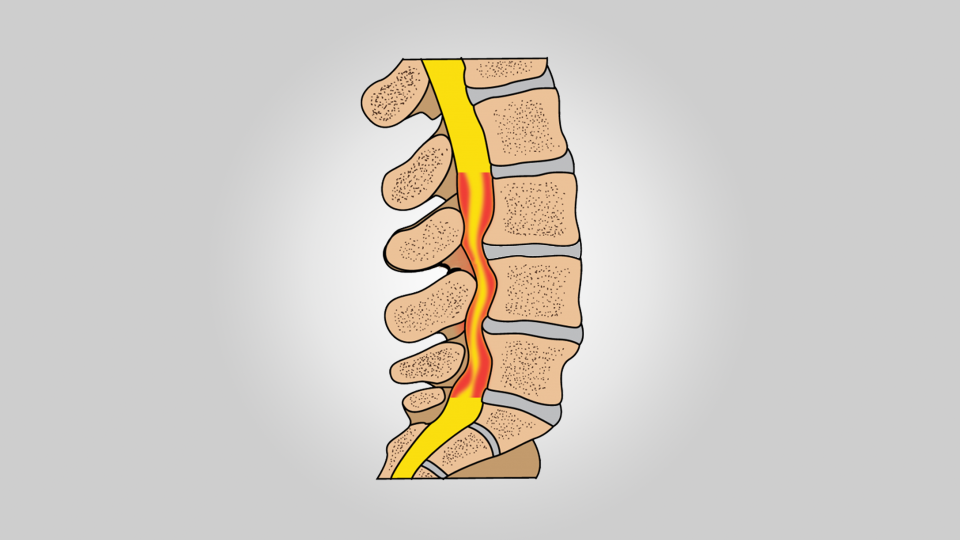 Lomber Dar Kanal (Spinal Stenoz)