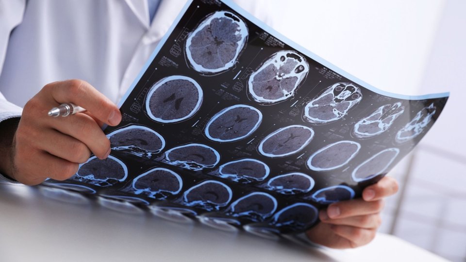 MS Hastalığı Neden Olur? MS Hastalığı Genetik mi?