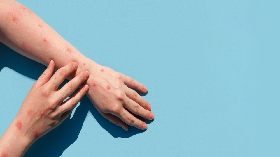 Maymun Çiçeği Belirtileri Nelerdir?