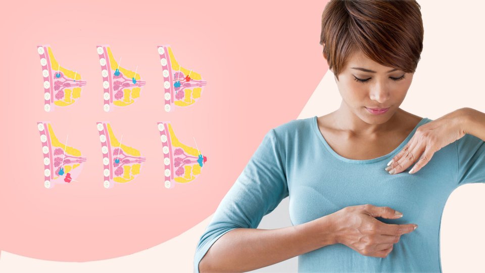 Meme Kanseri Tipleri Nelerdir?