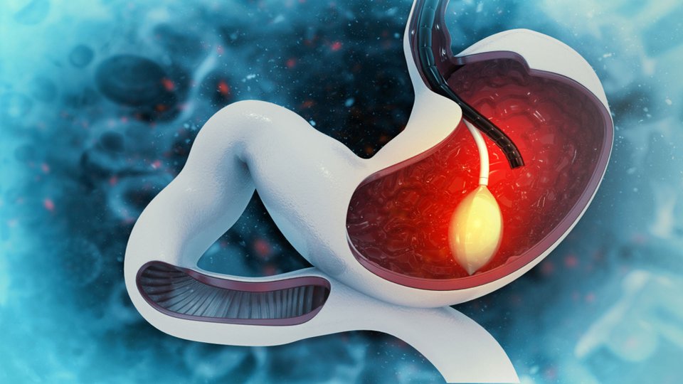 Mide Balonu (İntragastrik Balon) Nedir? Nasıl Uygulanır?