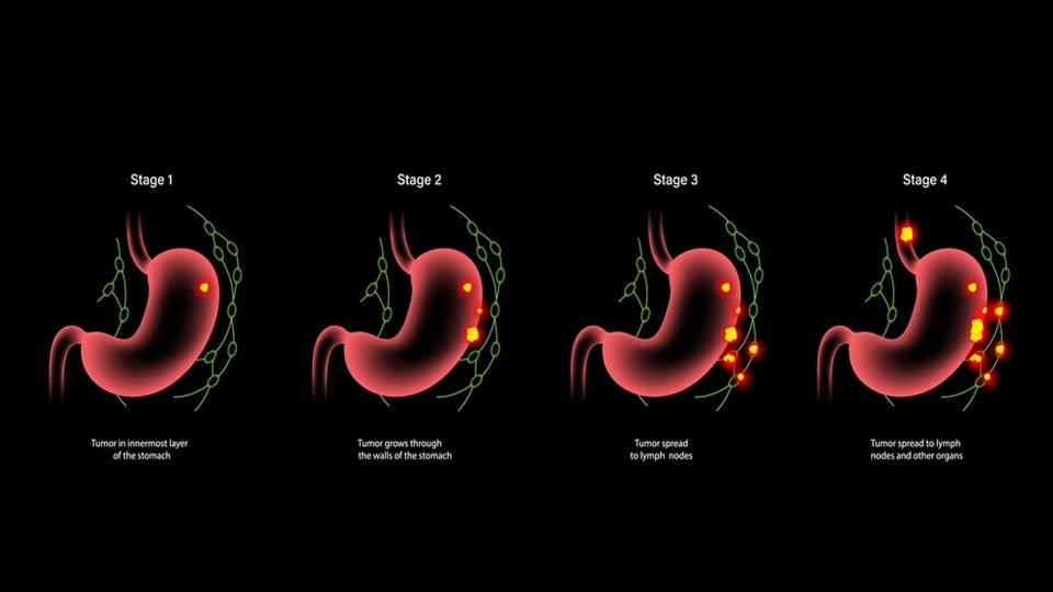 Dünyada Yaygın Görülen Kanser Türü Mide Kanseri Evreleri