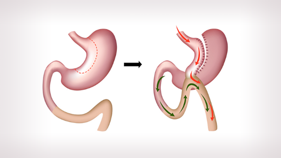 Mini Gastrik By-Pass Nedir?