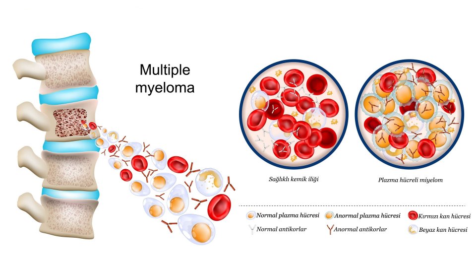 Multipl Miyelom Nedir? Tedavi Yöntemleri Nelerdir?