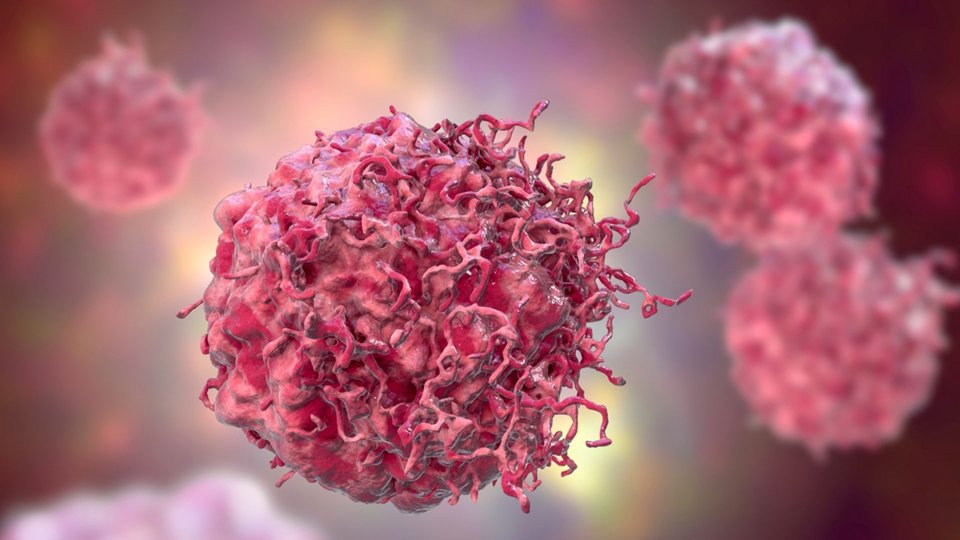 Nöroblastom Nedir? Nöroblastom Kanseri Belirtileri Nelerdir?