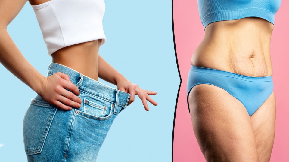 Obezite Cerrahisinden Sonra Sarkma Olur mu?