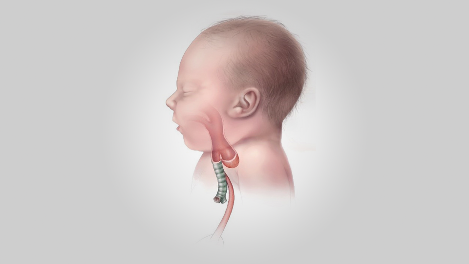 Özofagus (Yemek Borusu) Atrezisi